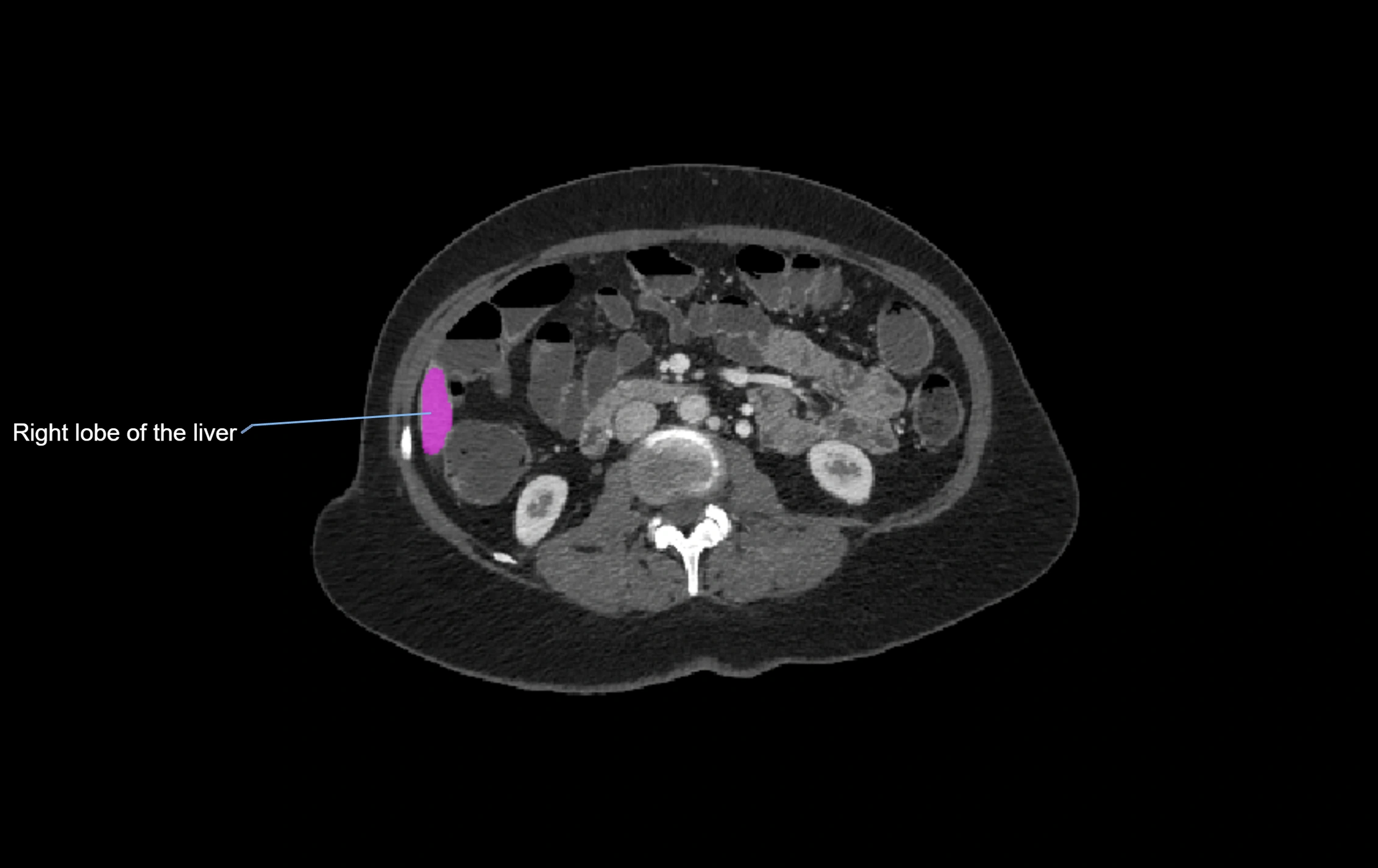 CT lliver lobes axial cross sectional anatomy labelled image -00005.webp